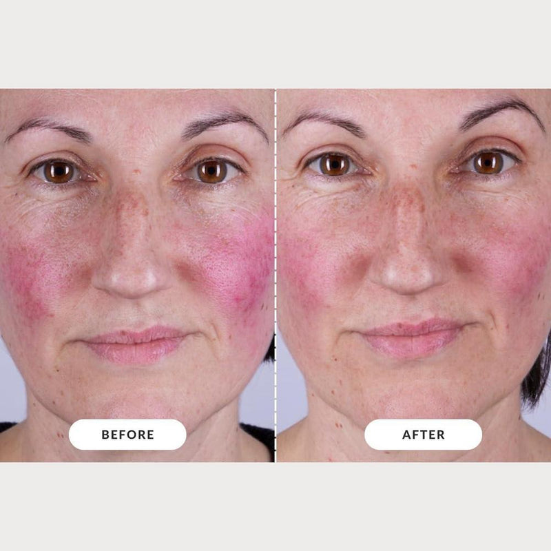 CurrentBody LED Mask - Kit completo