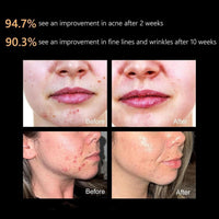 Mascarilla Facial Led Aphrona Aprobada Por Fda Con Fototerapia