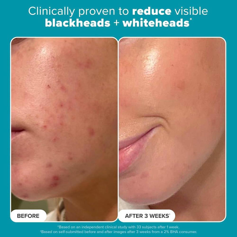 Paula's Choice Exfoliante 2% BHA Ácido Salicílico 118ml